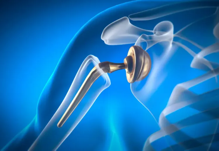 Impression 3D d'un implants orthopédiques 