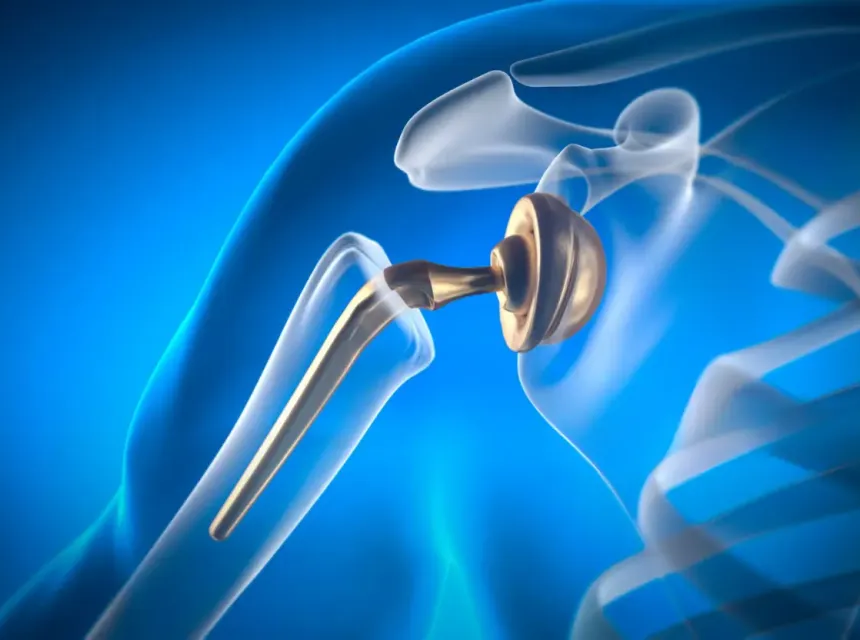 Impression 3D d'un implants orthopédiques 